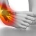 ankle sprain