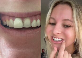 A woman spent ,000 for veneers only for them to fall off within 24 hours — and she wants to warn others about the irreversible procedure