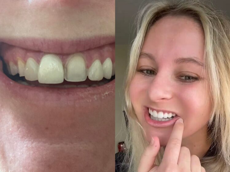 A woman spent $9,000 for veneers only for them to fall off within 24 hours — and she wants to warn others about the irreversible procedure