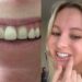 A woman spent $9,000 for veneers only for them to fall off within 24 hours — and she wants to warn others about the irreversible procedure