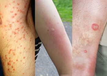 13 common bug bites and how to spot them