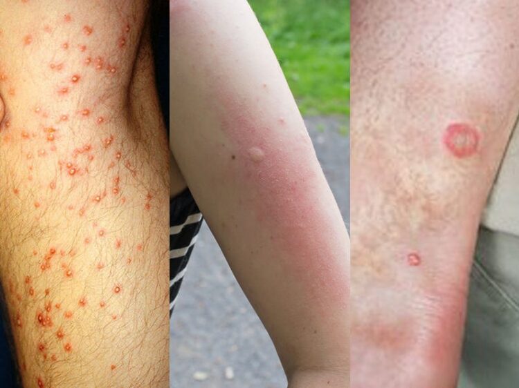 13 common bug bites and how to spot them