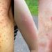 13 common bug bites and how to spot them