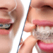 Aligners